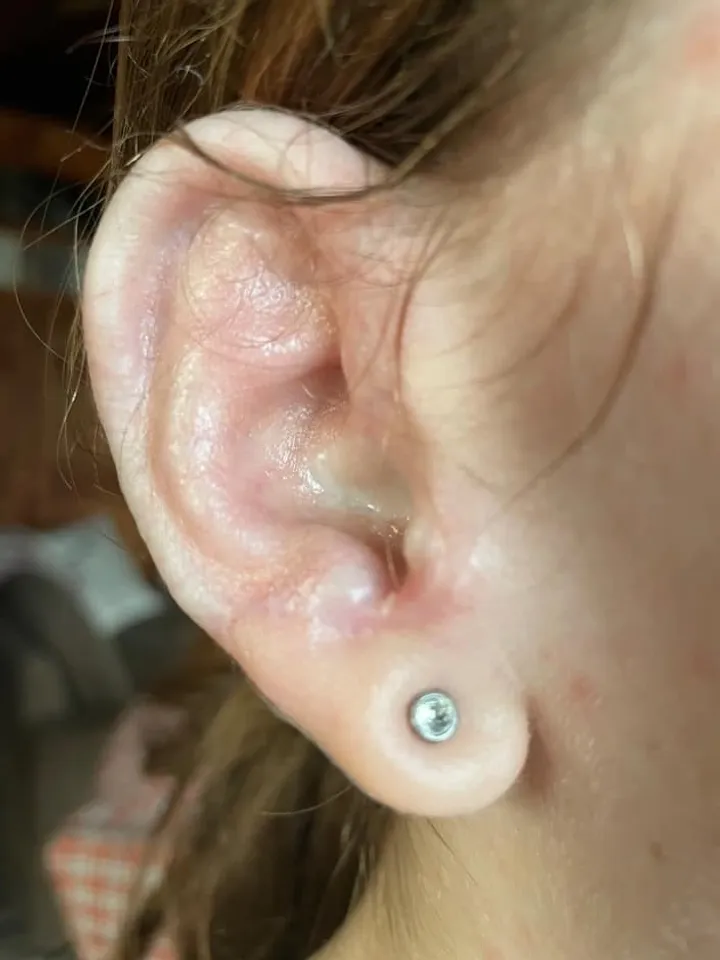 Polythylene Implant Ear Reconstruction