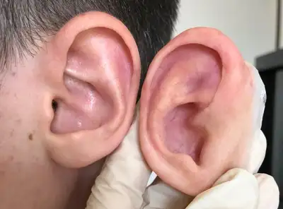 Prosthetic Ear