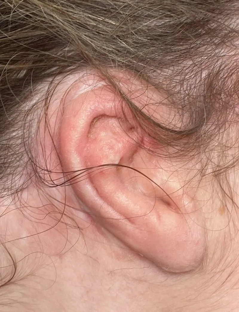 Rib graft ear reconstruction