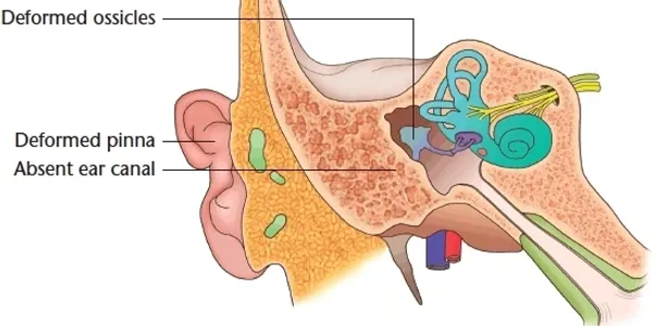 Diagram of cross-section of deformed ear anatomy