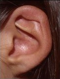 a picture of a Grade 1 microtia ear