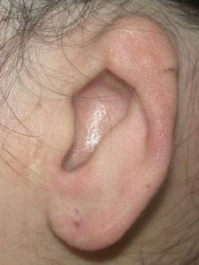a picture of a Grade 2 microtia ear