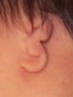 a picture of a Grade 3 microtia ear