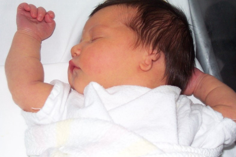 Baby with microtia and atresia